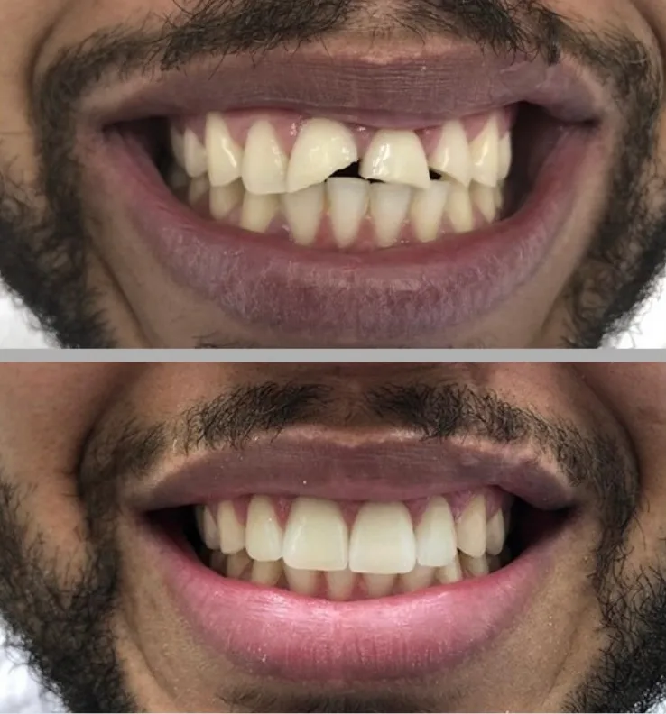 Reabilitação do sorriso: comparação de antes e depois do tratamento