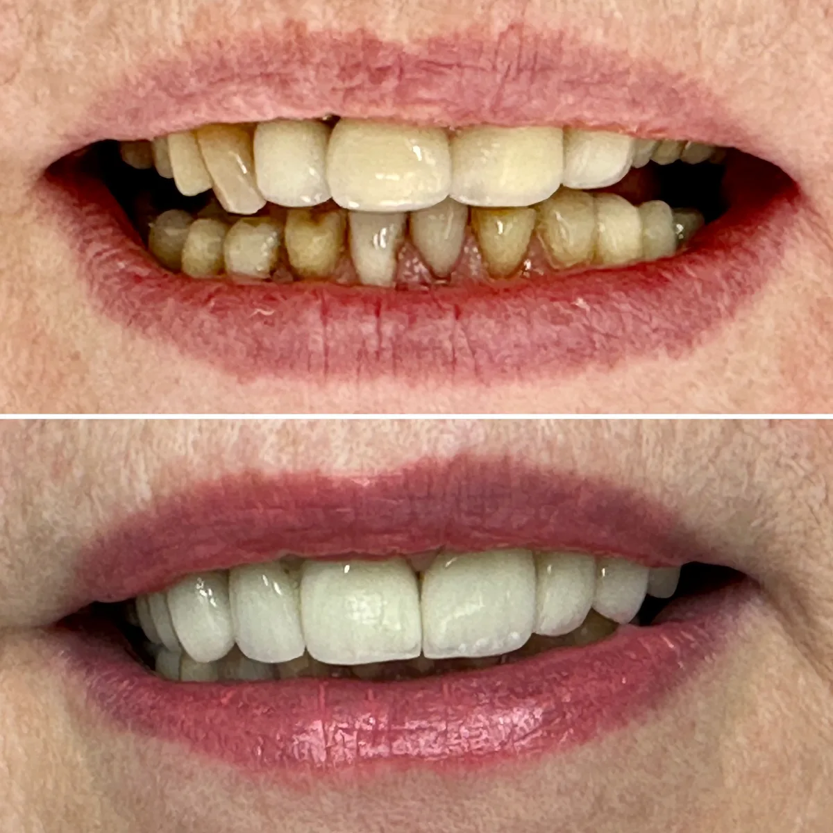 Reabilitação do sorriso: comparação de antes e depois do tratamento