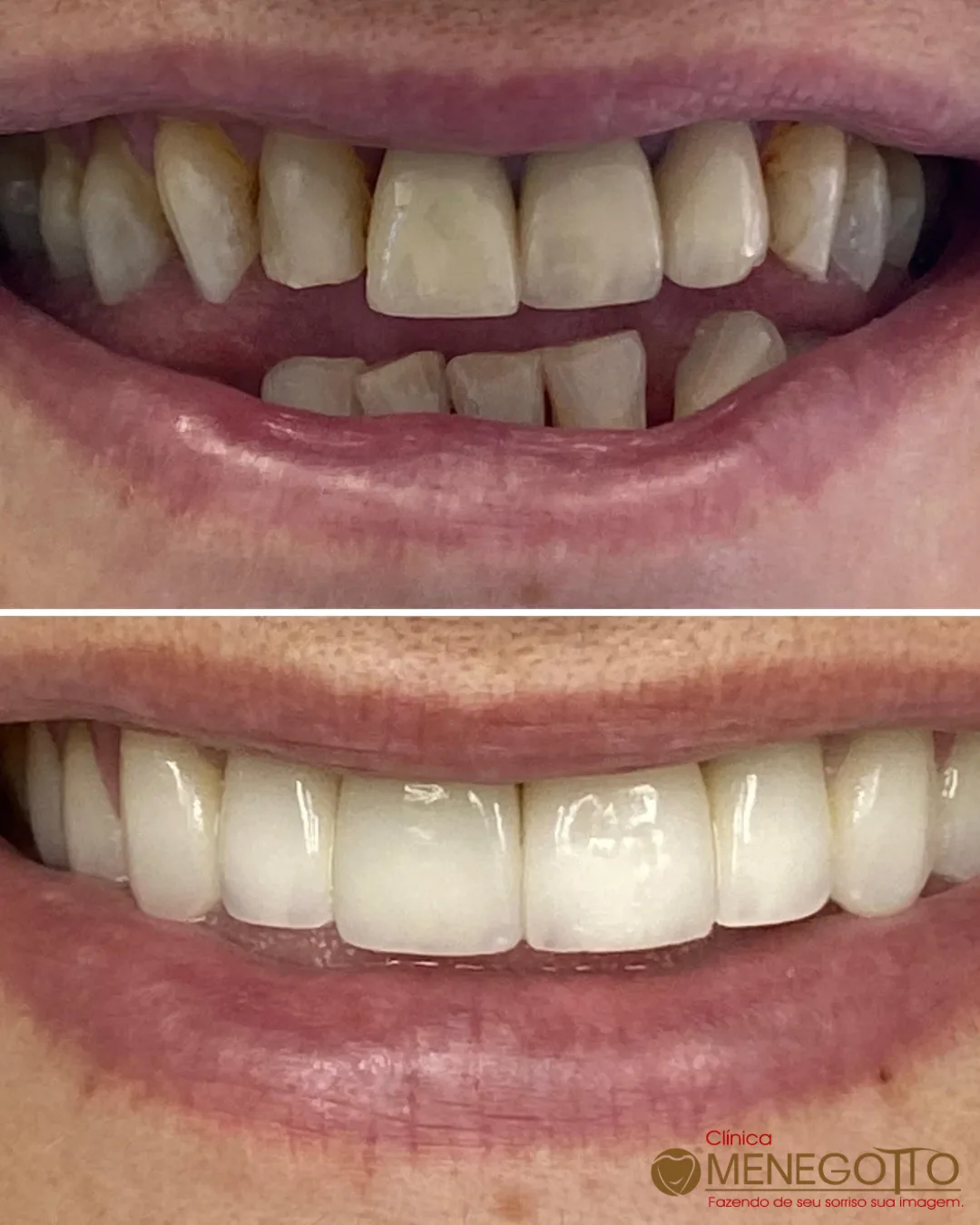 Reabilitação do sorriso: comparação de antes e depois do tratamento
