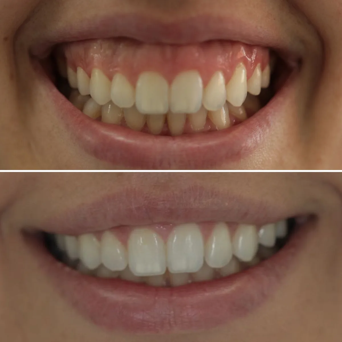 Reabilitação do sorriso: comparação de antes e depois do tratamento