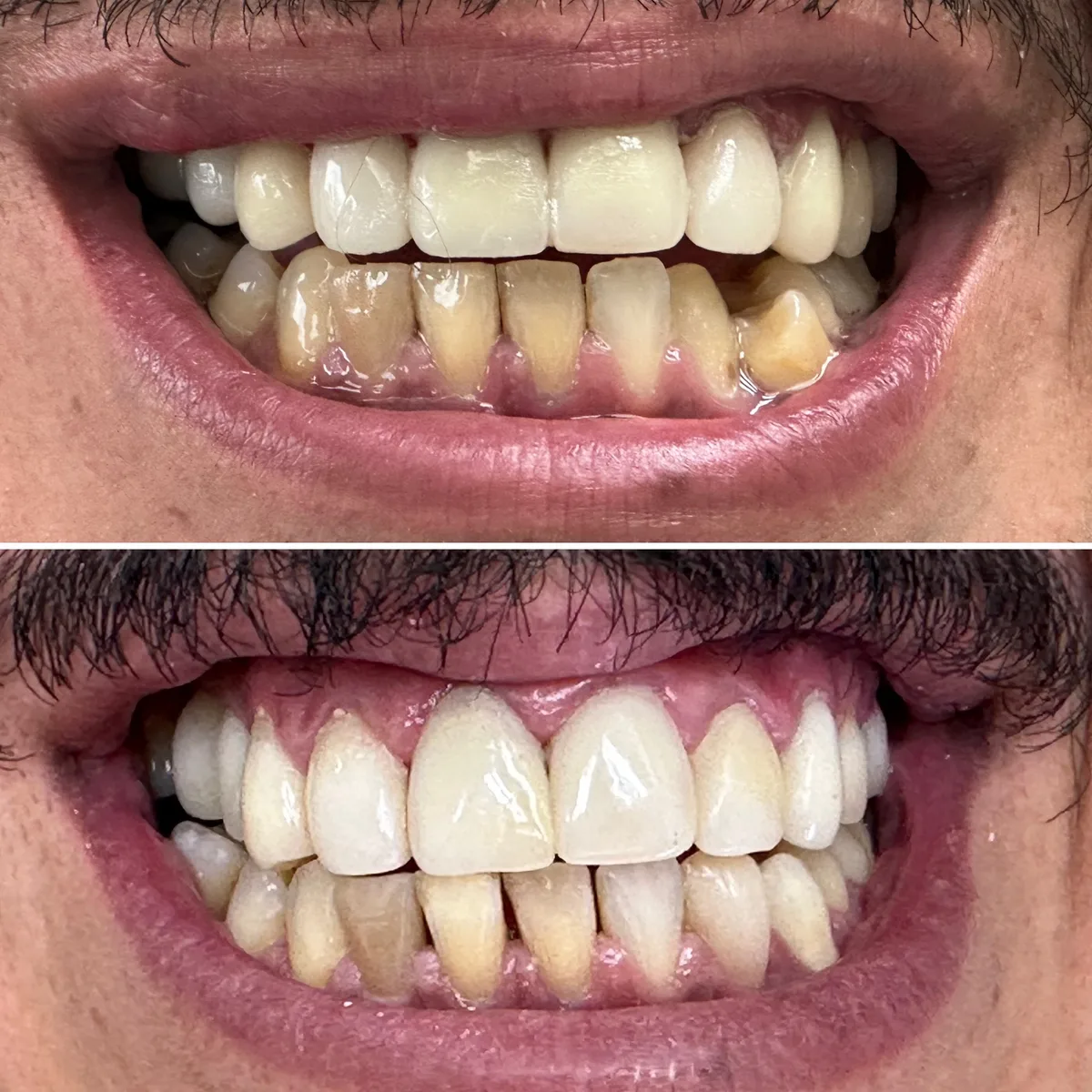 Reabilitação do sorriso: comparação de antes e depois do tratamento