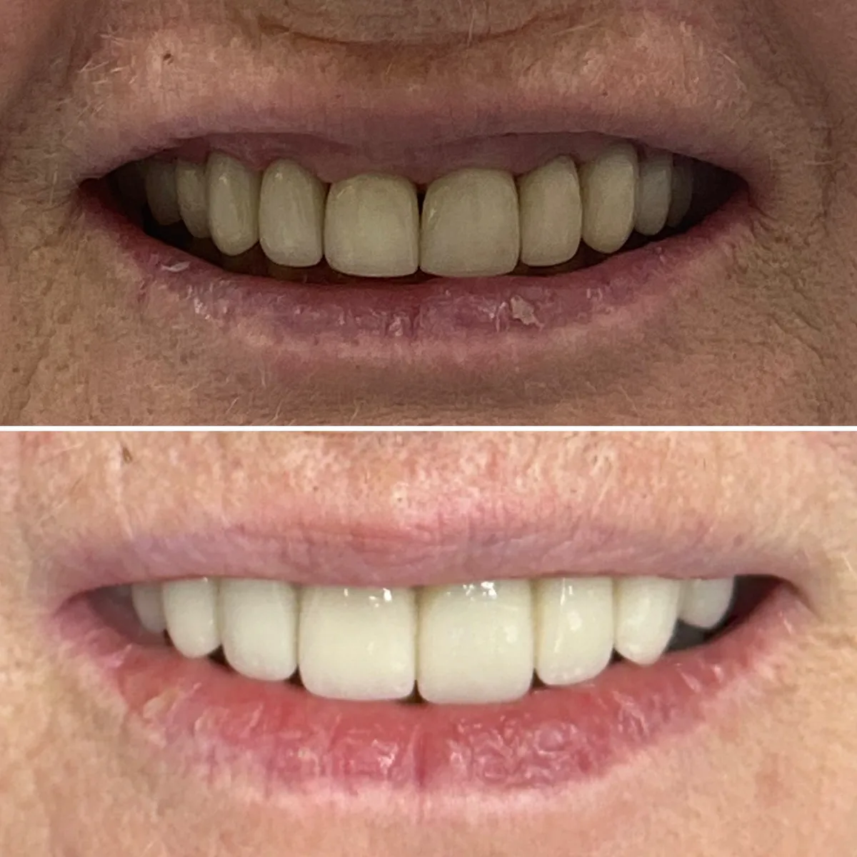 Reabilitação do sorriso: comparação de antes e depois do tratamento