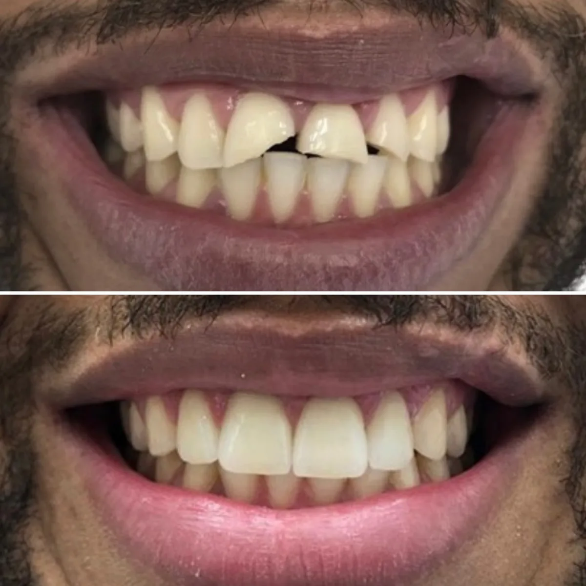 Reabilitação do sorriso: comparação de antes e depois do tratamento