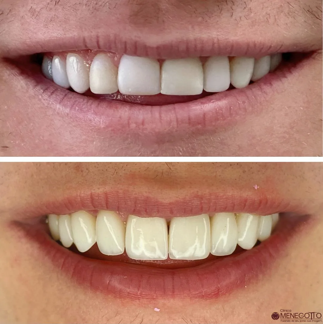Reabilitação do sorriso: comparação de antes e depois do tratamento