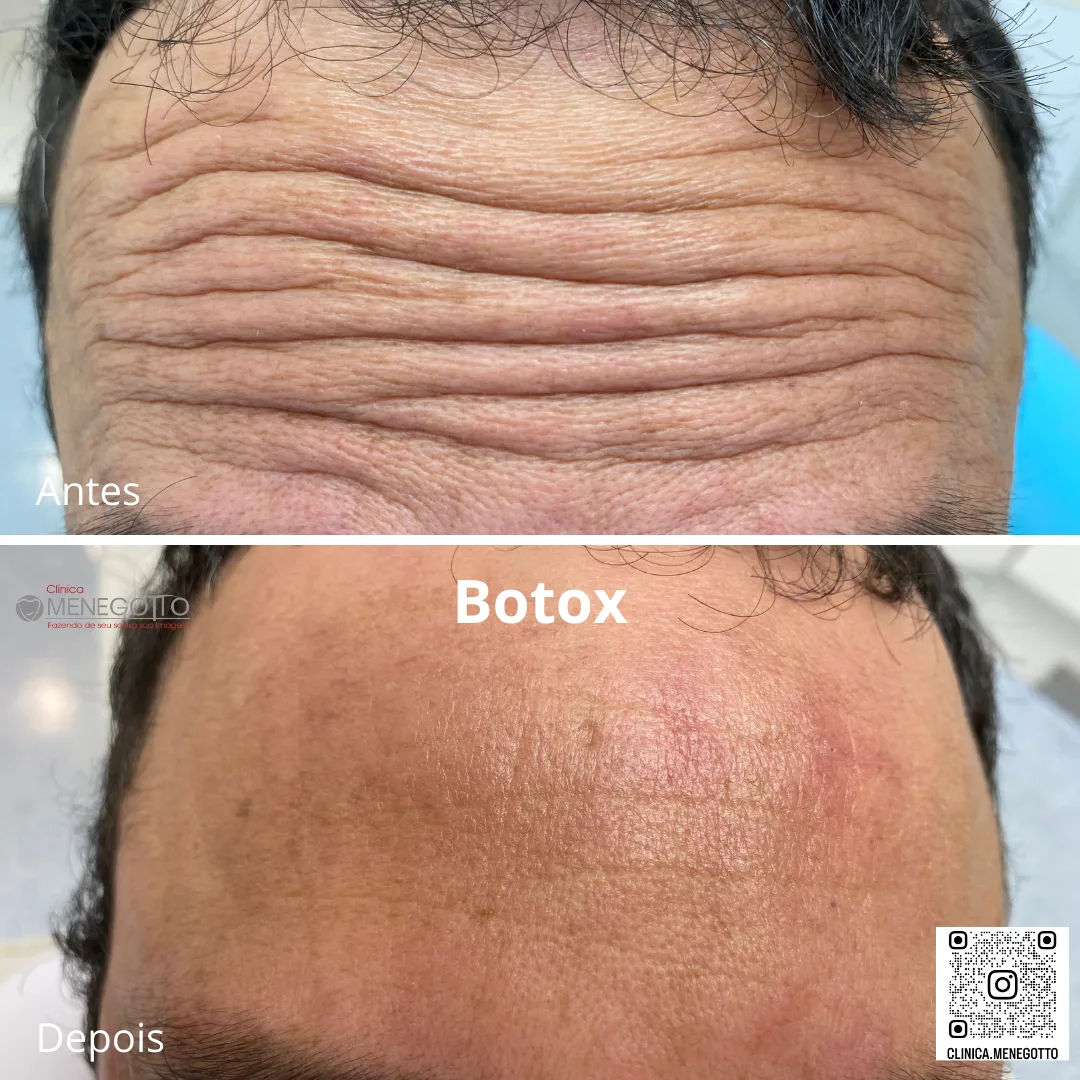 Toxina botulínica: comparação de antes e depois do tratamento