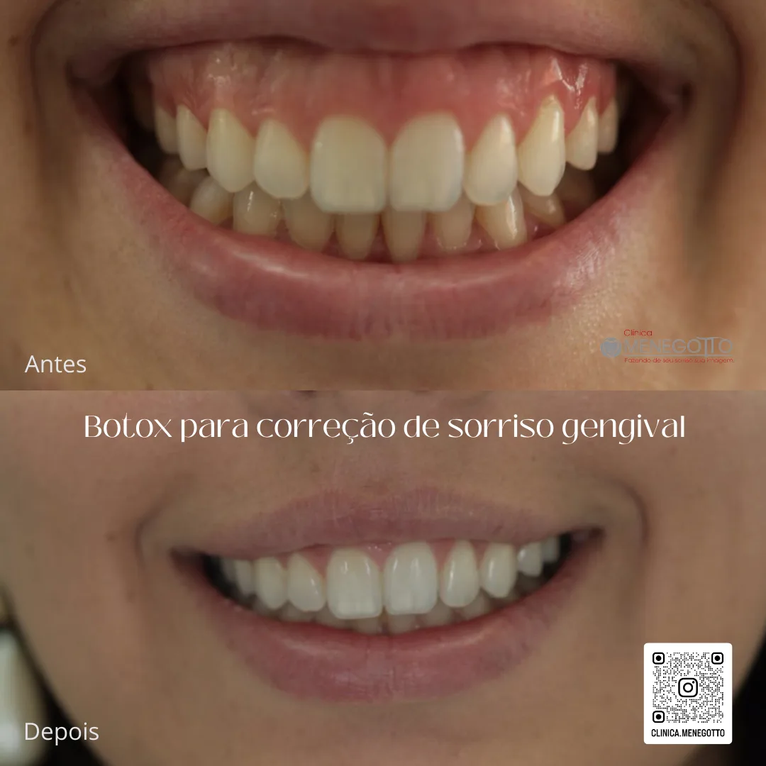 Toxina botulínica para sorriso gengival: comparação de antes e depois do tratamento