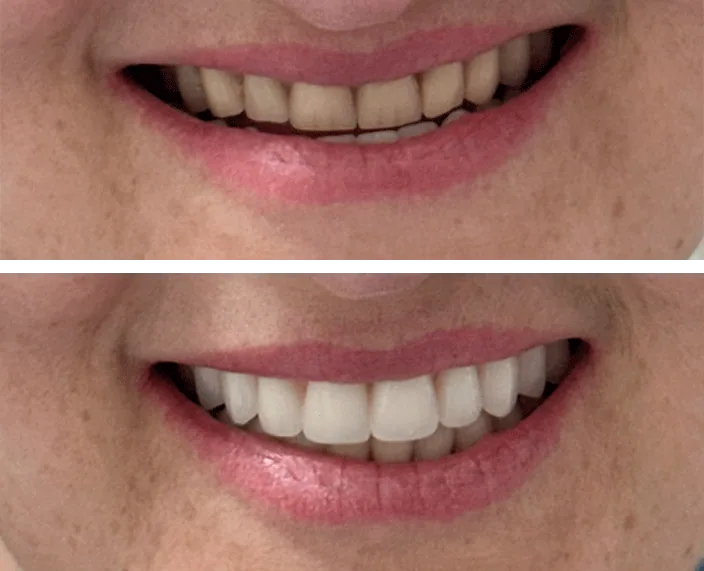 Prótese Dentária: comparação de antes e depois do tratamento