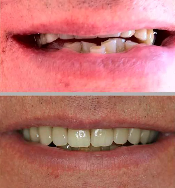 Prótese Protocolo: comparação de antes e depois do tratamento
