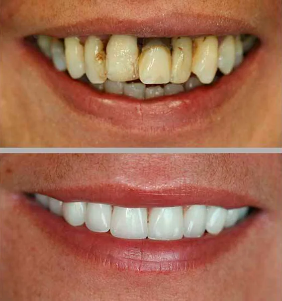 Prótese Protocolo: comparação de antes e depois do tratamento